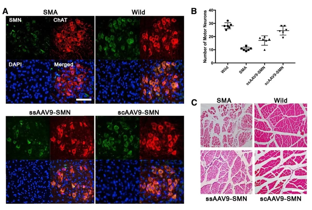 与时间赛跑，基于rAAV9载体胎儿基因治疗SMA新进展（一）